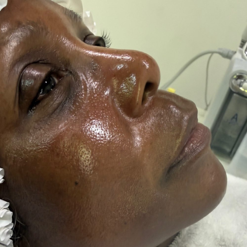 Golden Hour Hydrafacial at The Vanity Club in Atlanta, GA