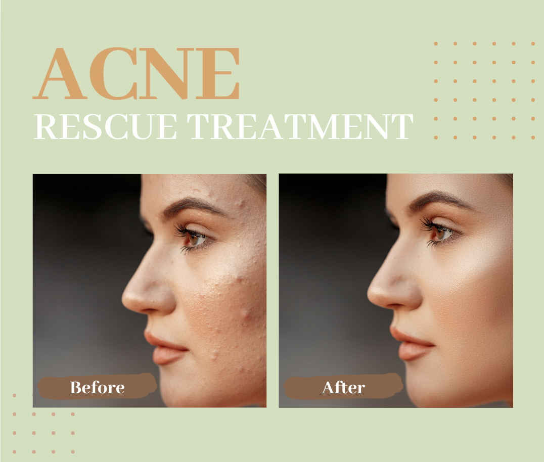 Acne Rescue Facial