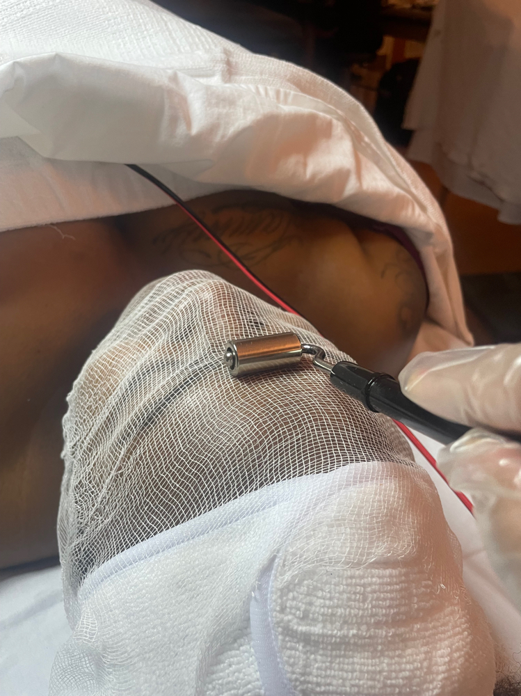 Acne Clearing Facial at Runway Esthetics in Racine, WI