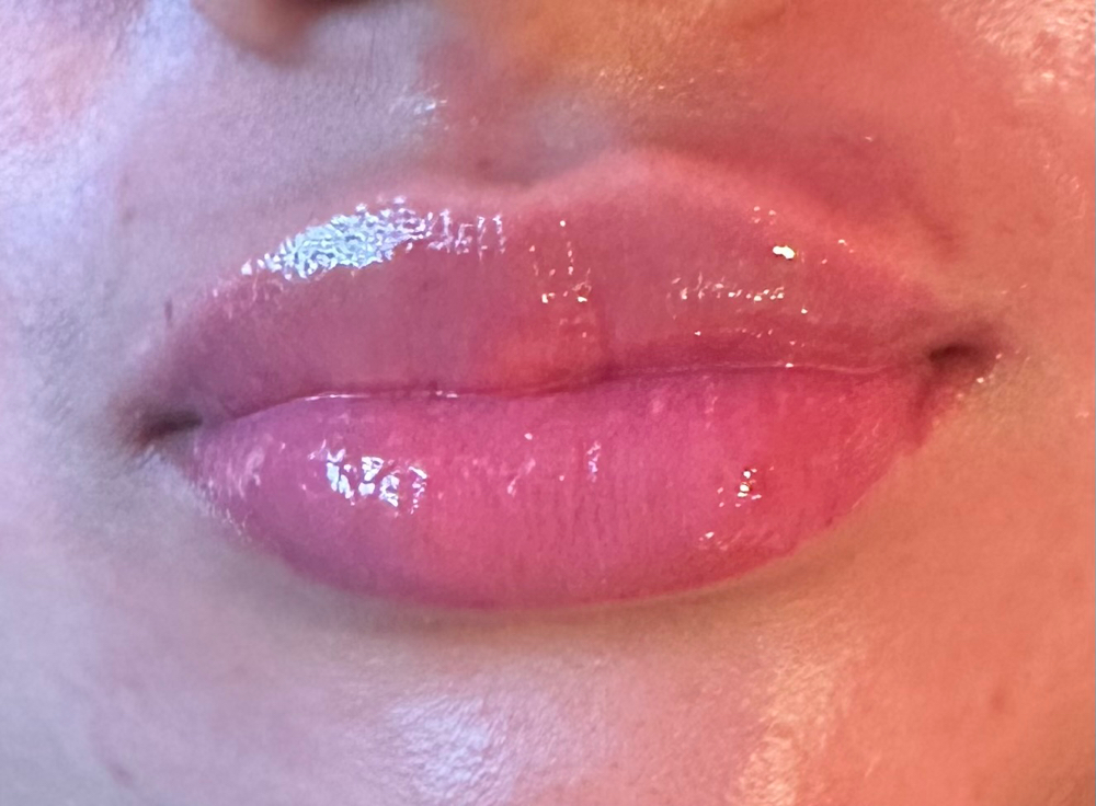 Botox Lip Flip