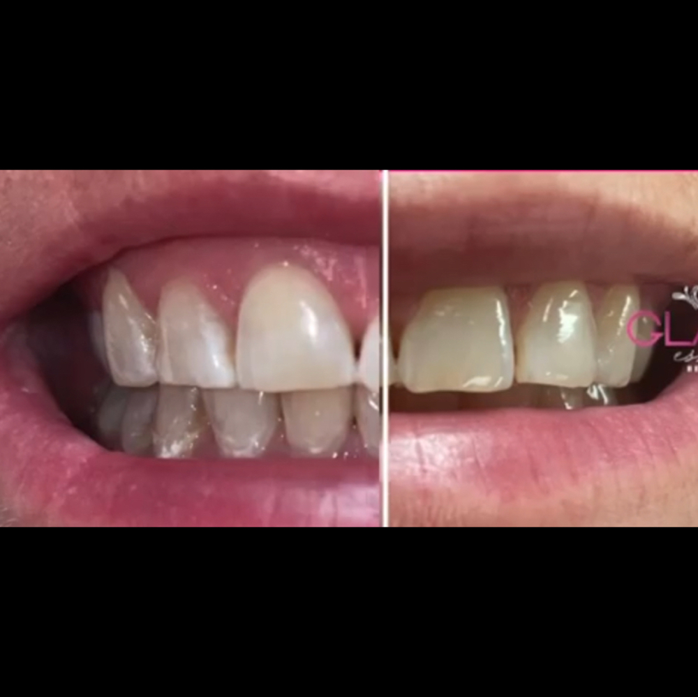 30 Minute Teeth Whitening