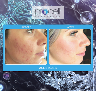 Procell Clinical Face and Neck