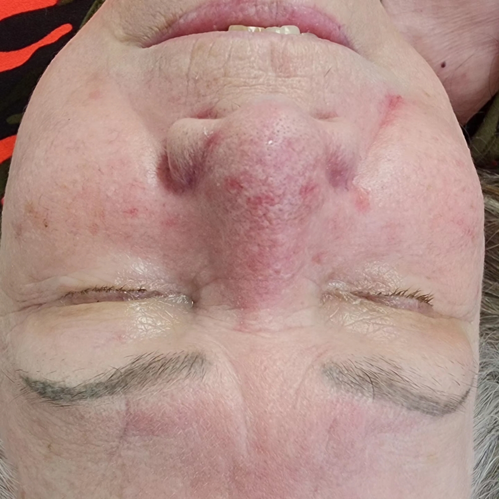 Facial With Dermal Suction