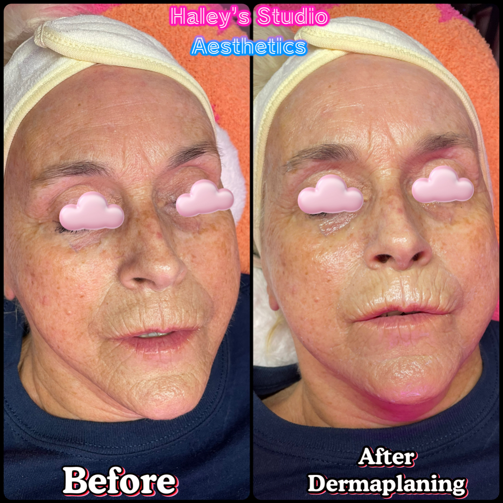 Dermaplane Skin Therapy