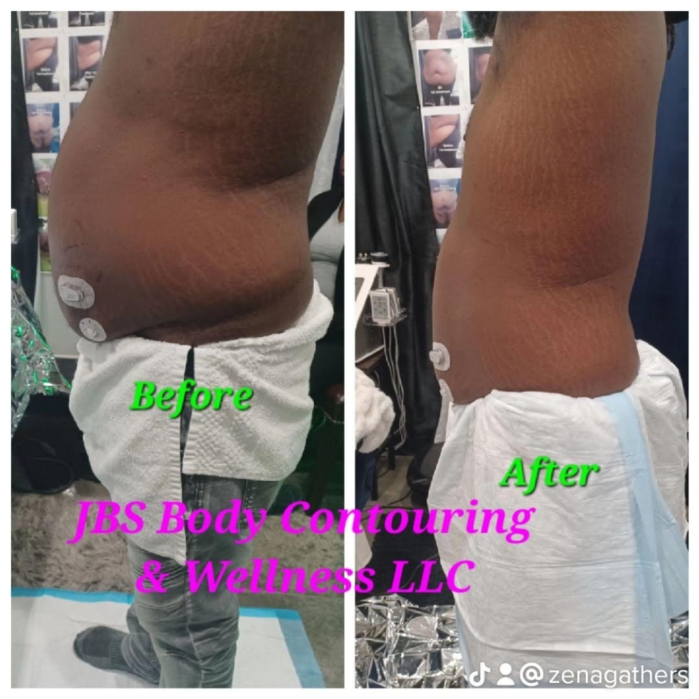 🔥4 Tre Stomach Reduction at JUST BEAUTIFUL SKIN in Goose Creek, SC
