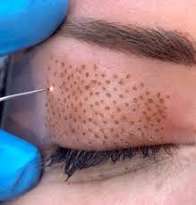 Fibroblast at perlas beauty in el paso, TX