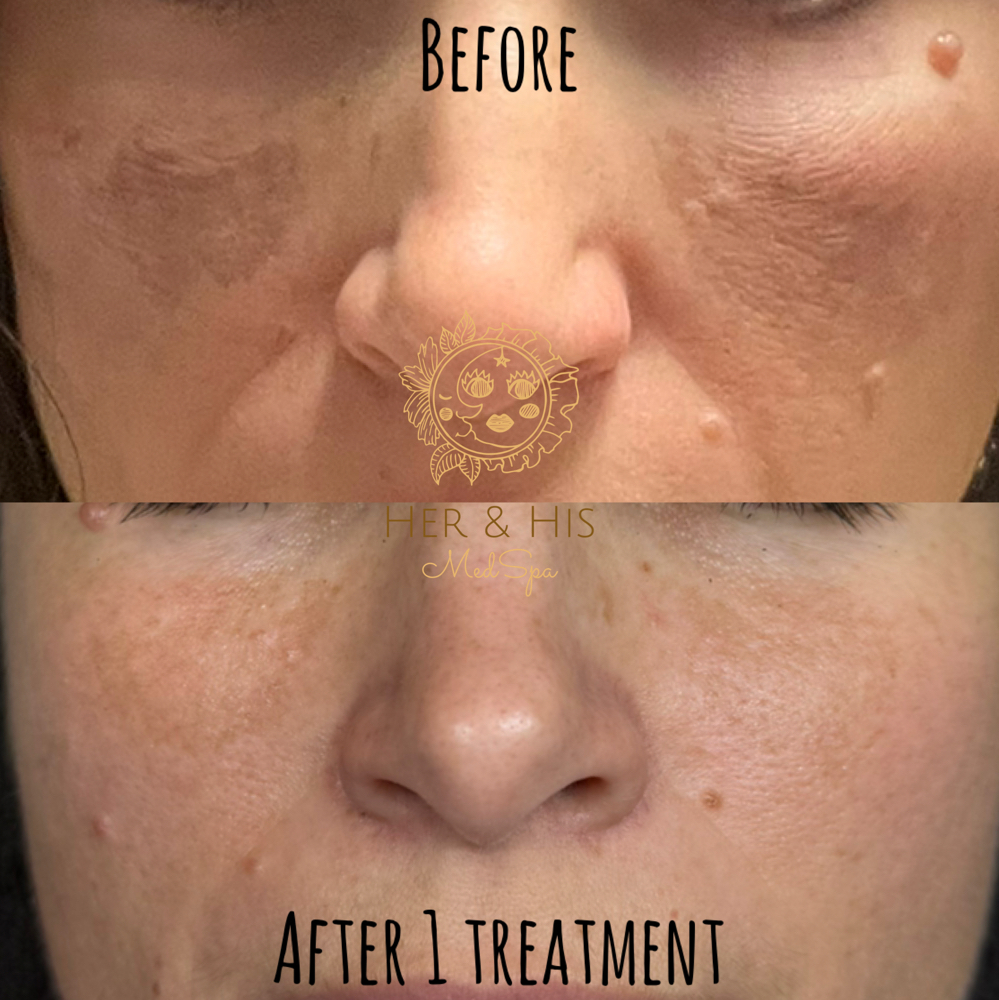 BioRePeel Deluxe + Mesotherapy