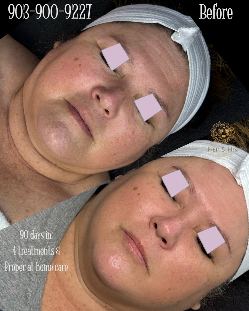 BioRePeel Deluxe + Mesotherapy