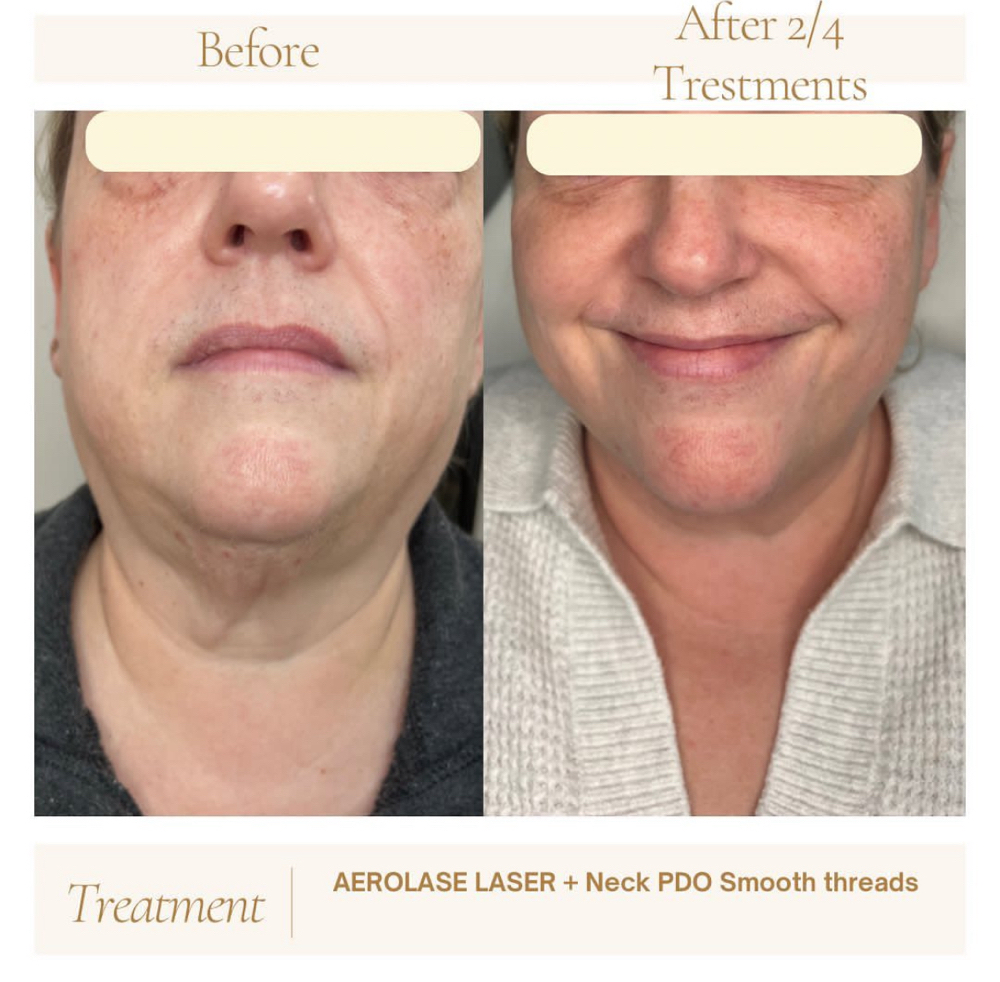 Neck Tightening Aerolase Laser