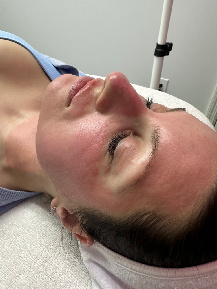 Microneedling Package