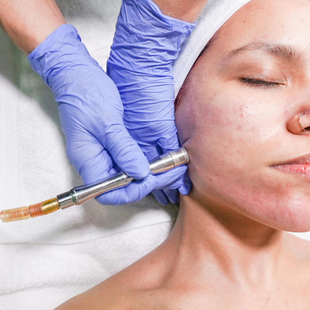 Clear Skin Protocol at Flow and Glow RN in Corona, CA
