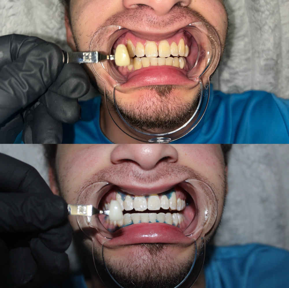 Teeth Whitening (30 Mins)