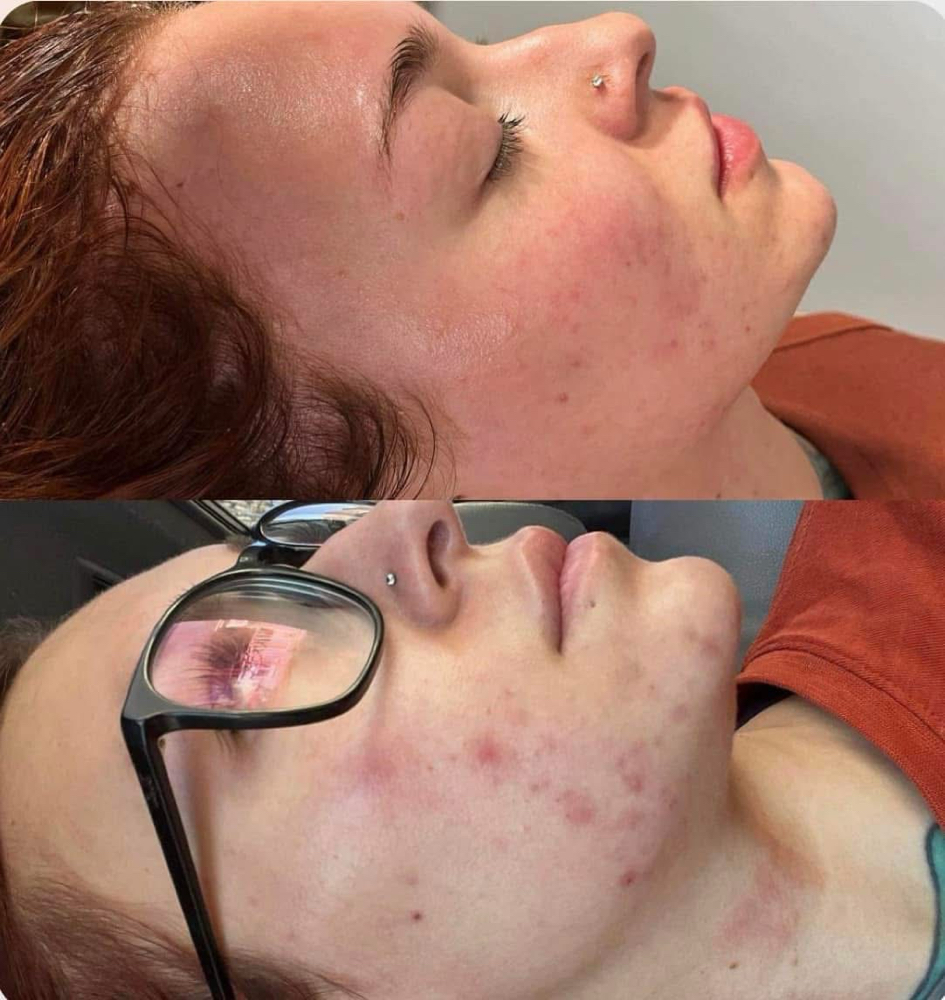 Teen Facial