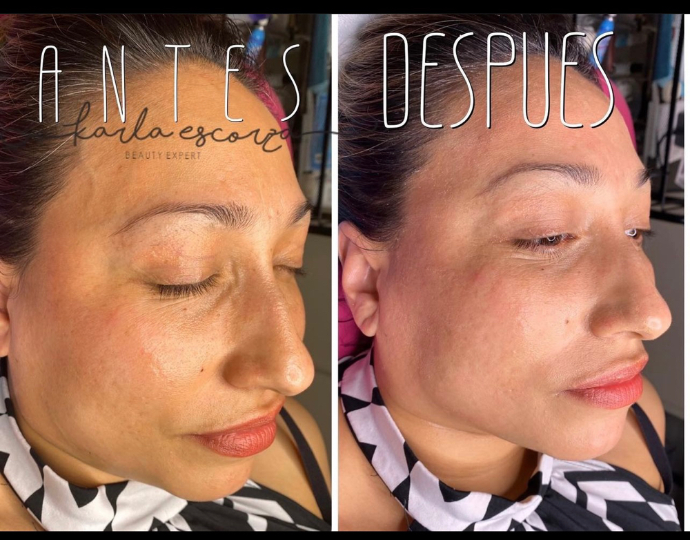 Facial + Microneedling at LASHES AND BROWS By Karla Escorza in Northglenn, CO