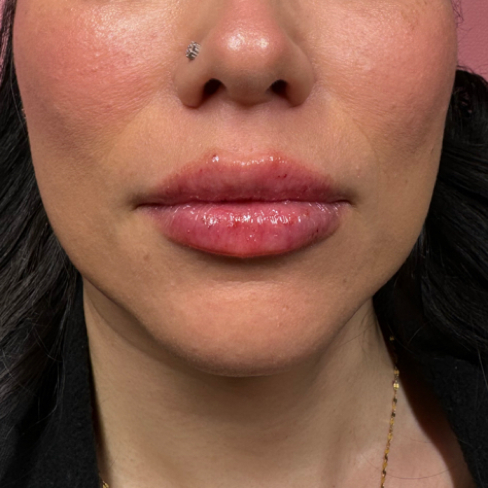 2 ML Needle-less Lip Enhancement at divinebeautyarizona in Phoenix, AZ