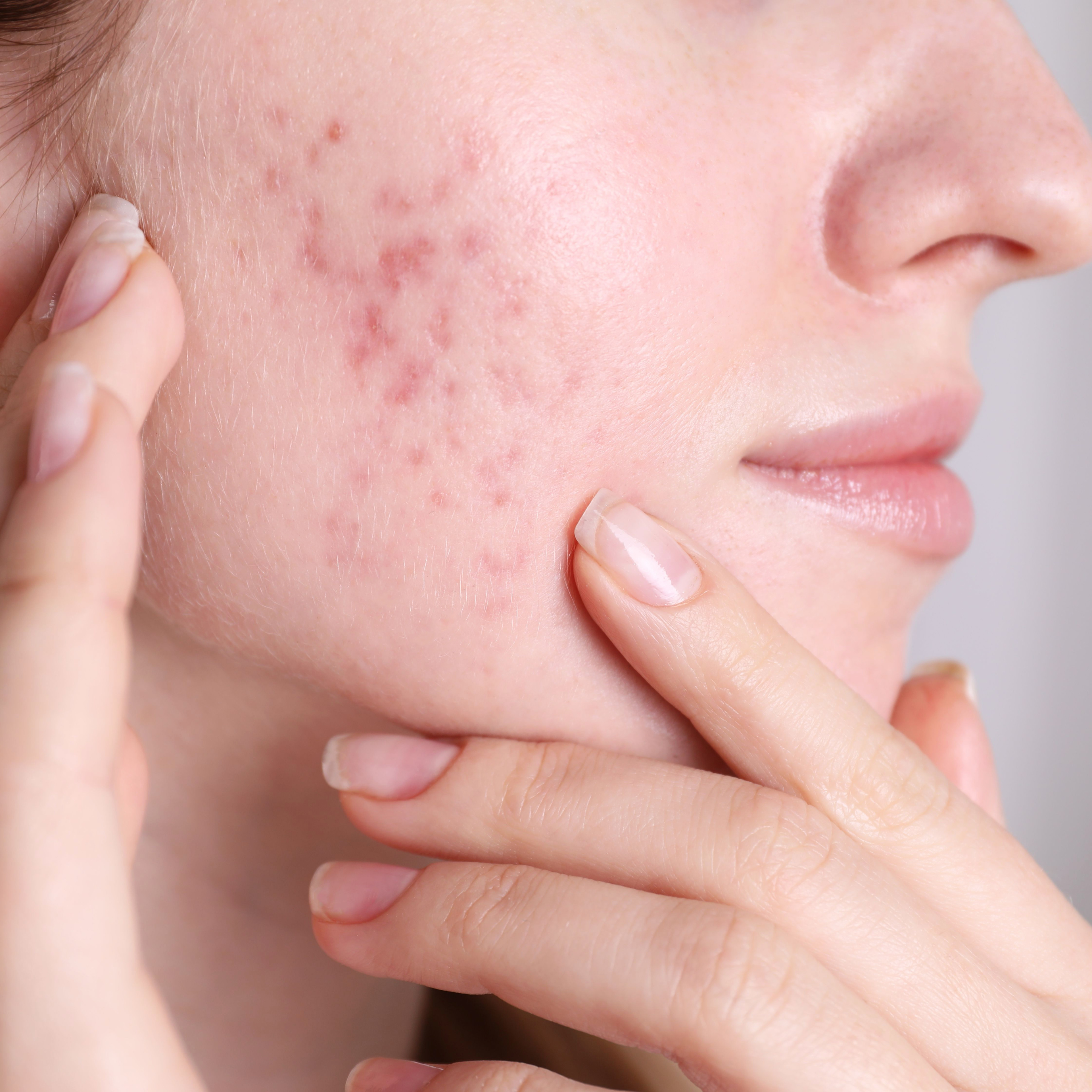 Acne Facial