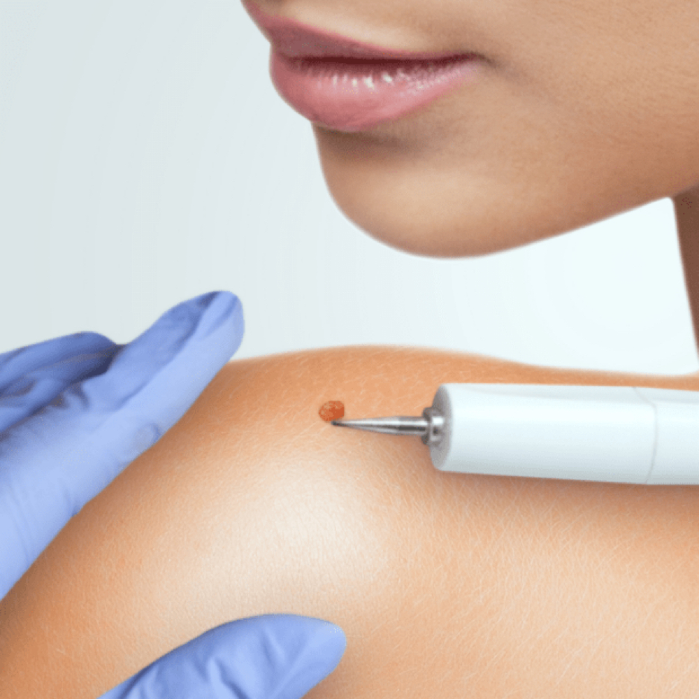 WART REMOVAL (verrugas) at Glow skin aesthetics in Addison, TX