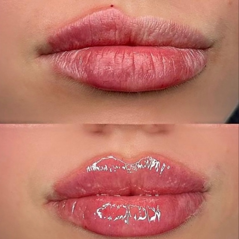 Lip Enhancement at The Lash Room SLC in West Valley City, UT