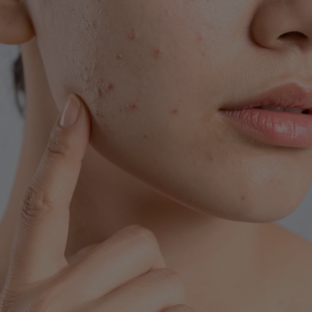 Acne Hydrating Treatment at The BOB Salon in Fort Wayne, IN