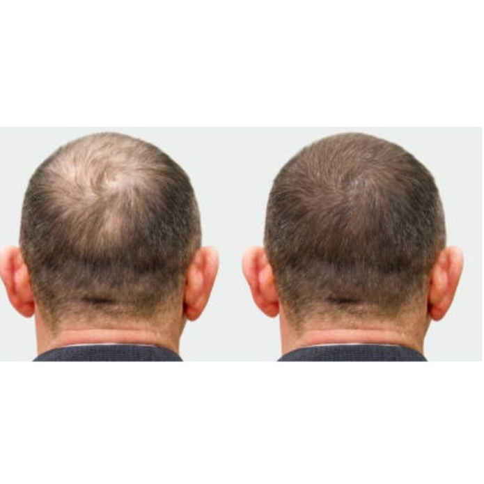 Nue Strand Hair Regeneration