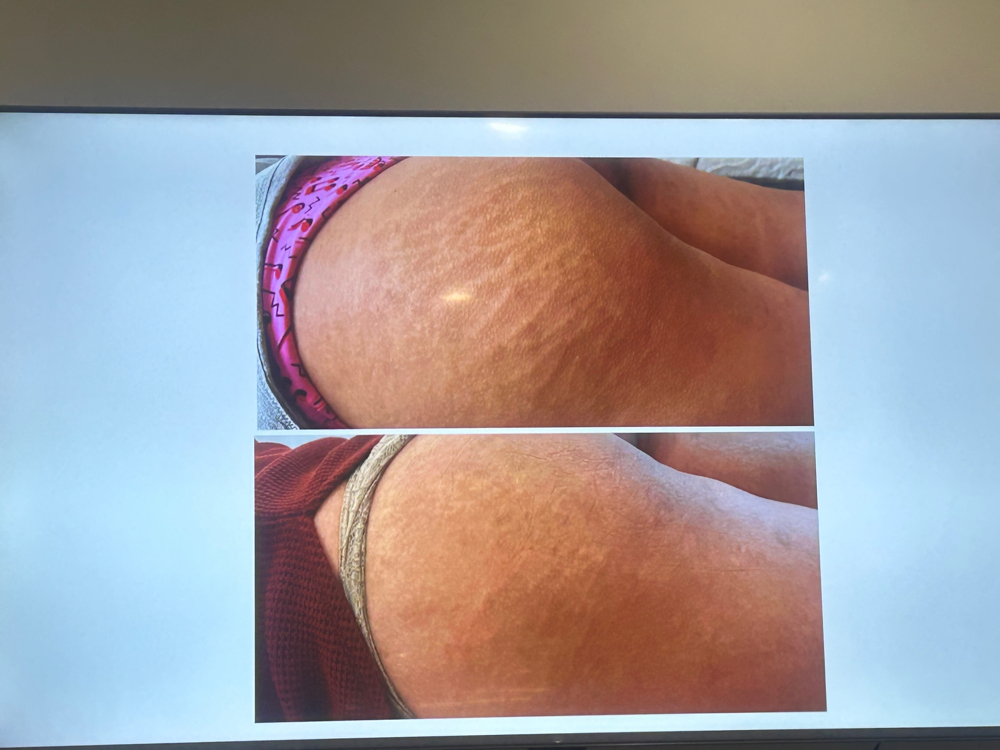 Inkless Stretch Mark Revision