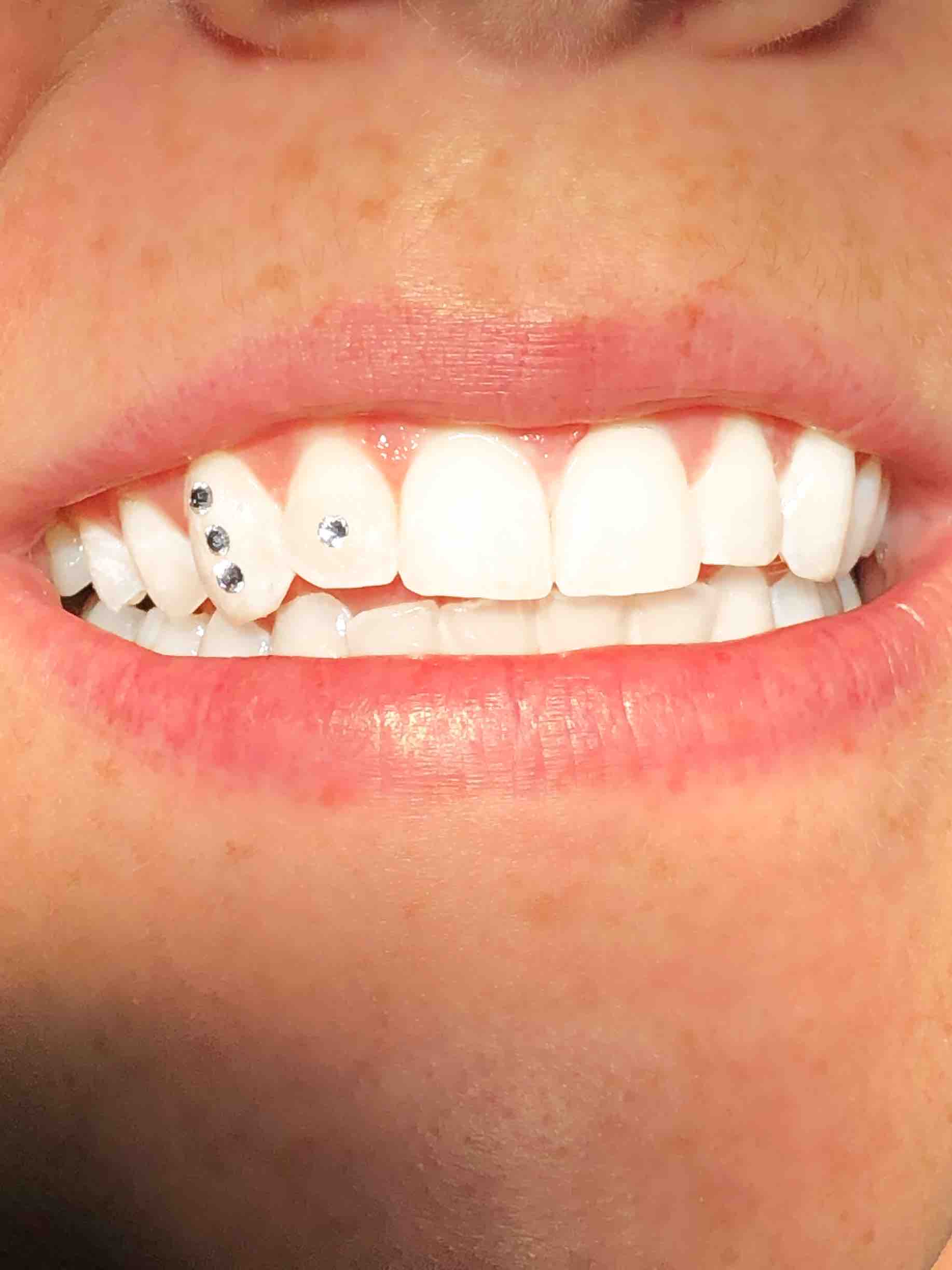 Teeth Gems