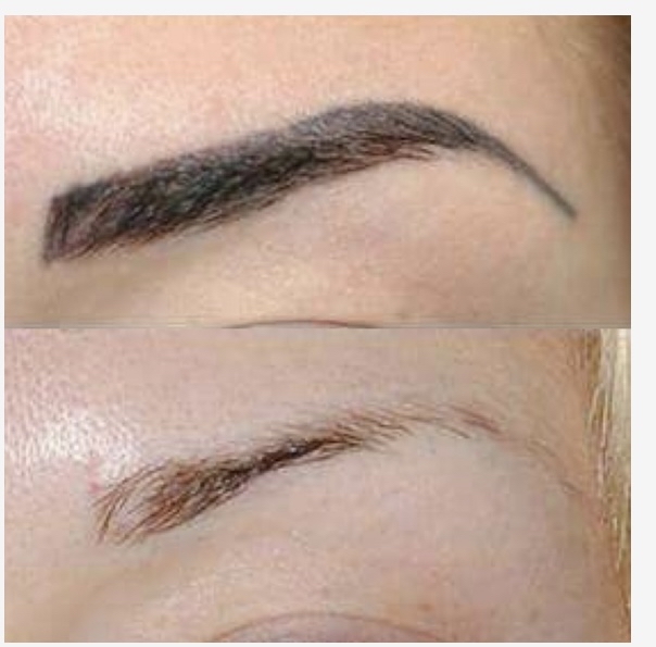 Brow Tattoo Removal / Lightening