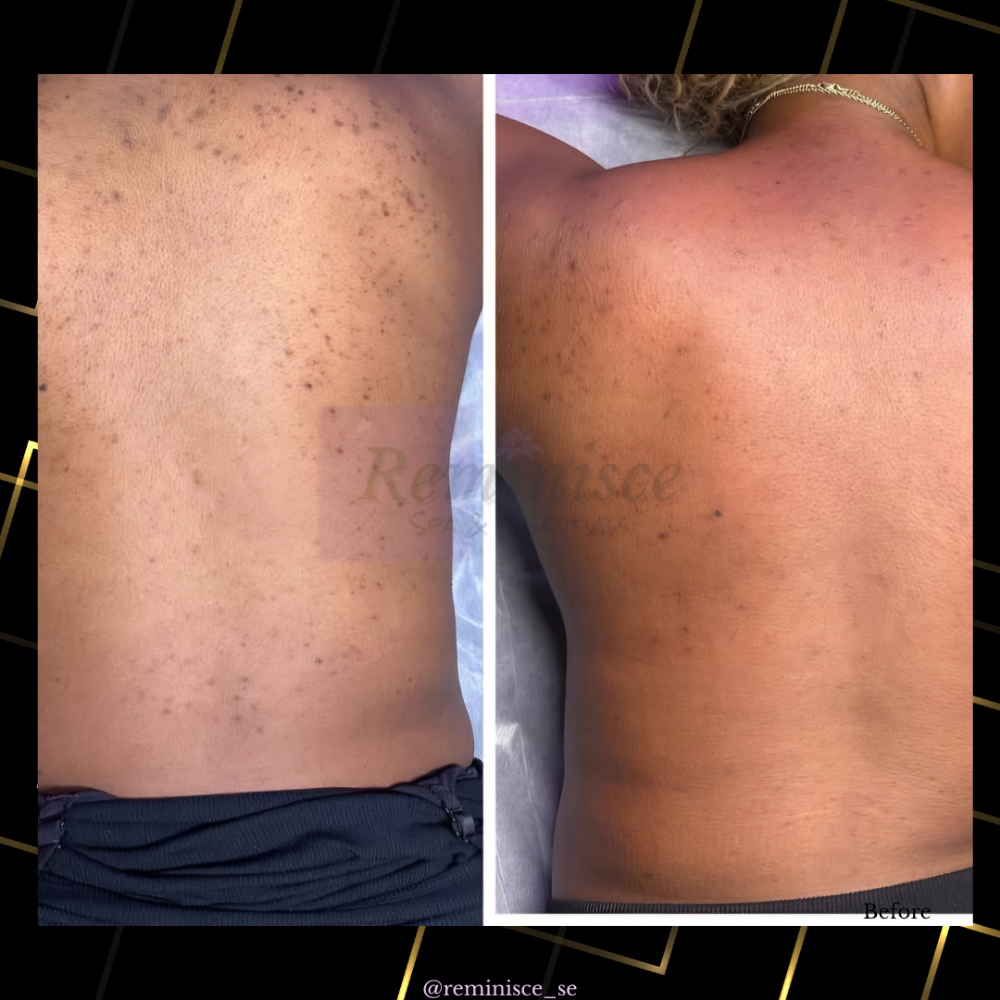 Back Microneedling & Peel Combo