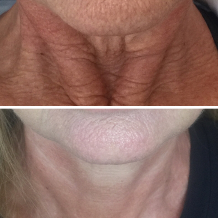 Fibroblast Treatment (Neck Lift) at Luscious Tox Aesthetics in Arlington, TX