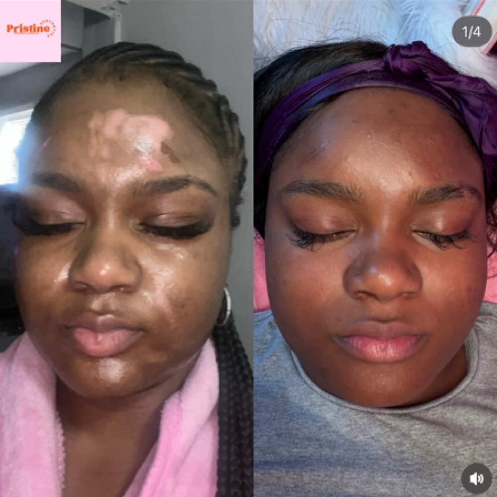 Microneedling Glow Reset Tx at Pristine Aesthetics in Redford, MI