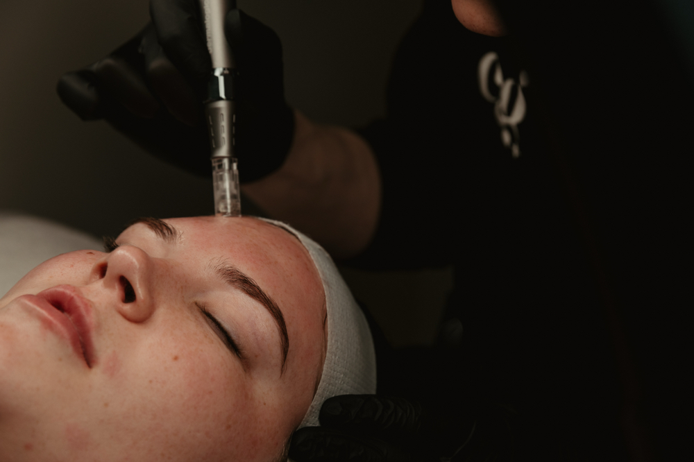 6 Microneedling Sessions