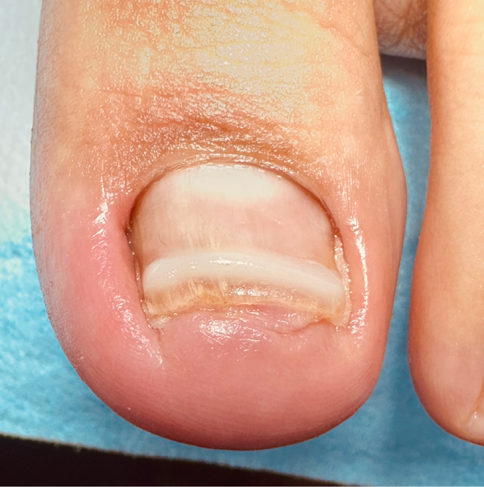 (Onyfix) Add On by Aracely at Confident Foot Care by Aracely Xicara in Huntington Park, CA