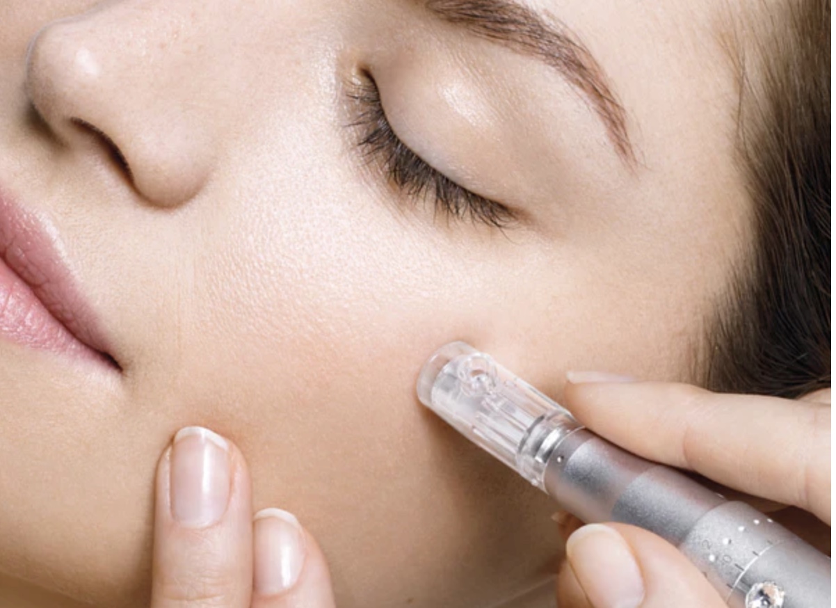 Microneedling