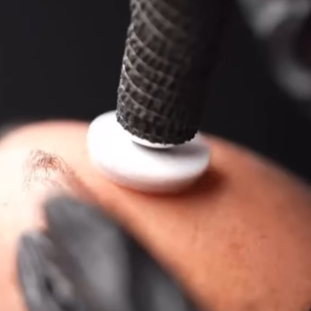 Procell Microchanneling Face Only at Skin Resort in Sterling Heights, MI