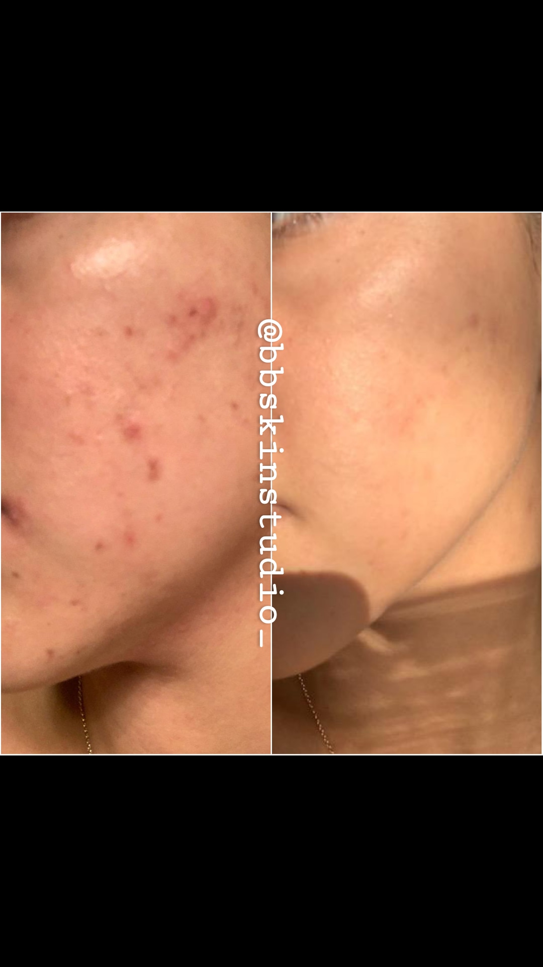 Crystal Clear Acne Facial