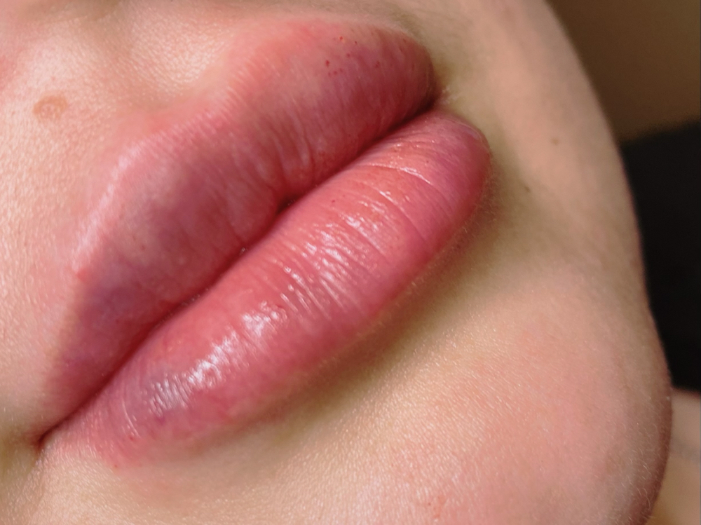 Needless Lucious Lips 1ml