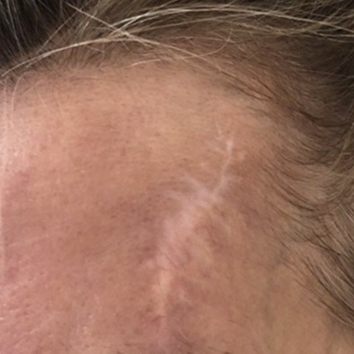 Scar Camouflage at Own Your Journey Studio in Dana Point, CA