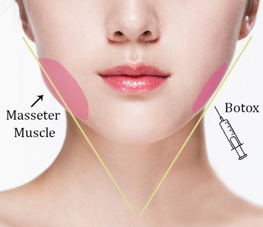 Masseter Botox