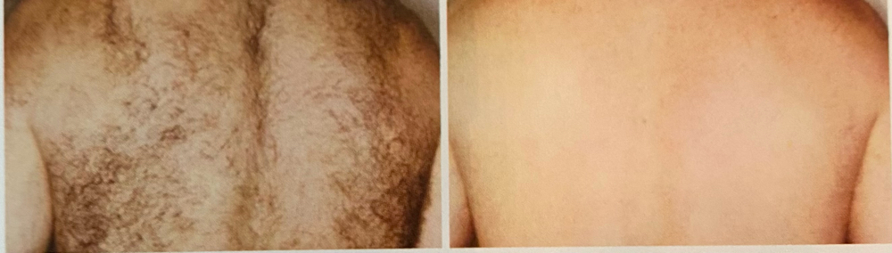 Laser Hair Removal Full Back