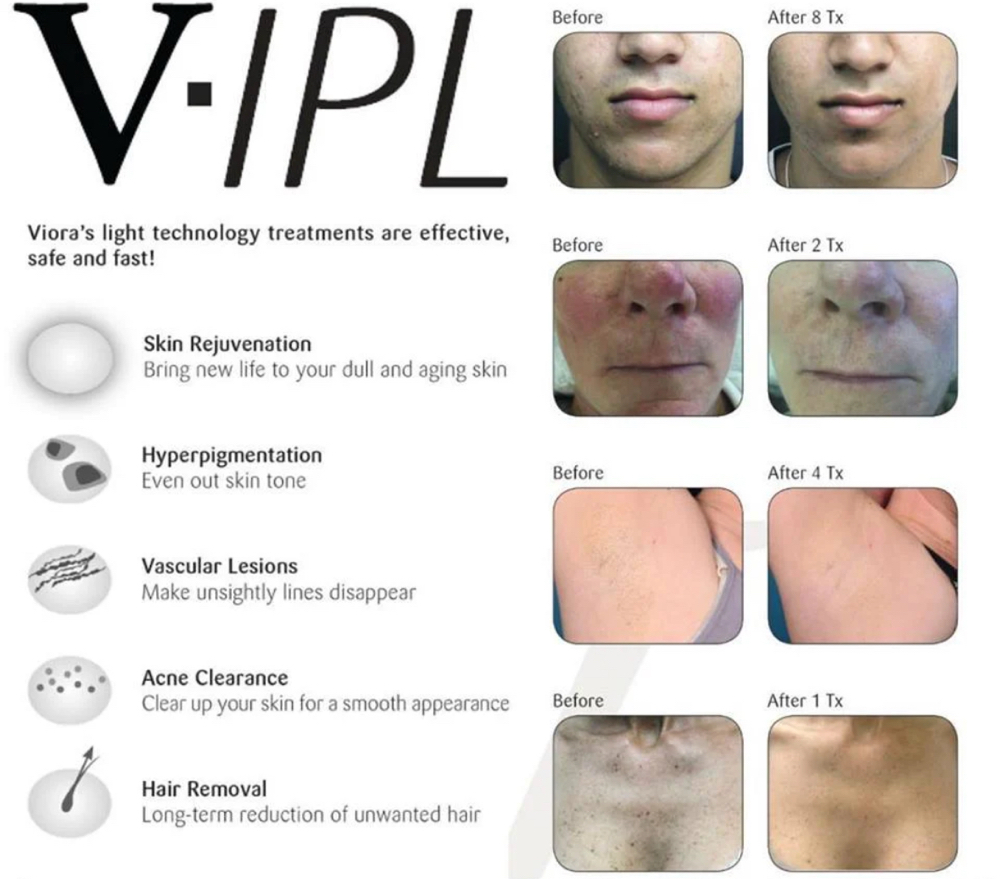 IPL Photo facial at Island Glow in Londonderry, NH