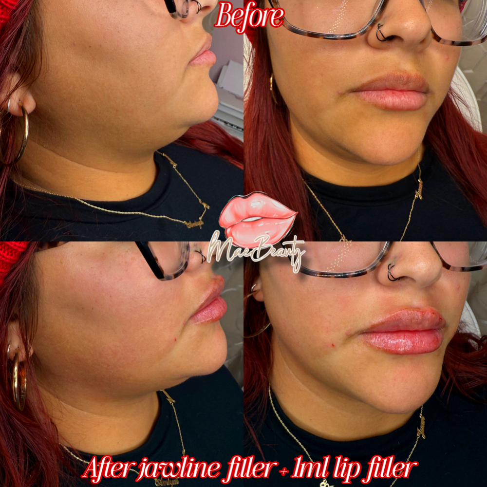 Jawline Augmentation at MaeBeauty in Mesquite, TX