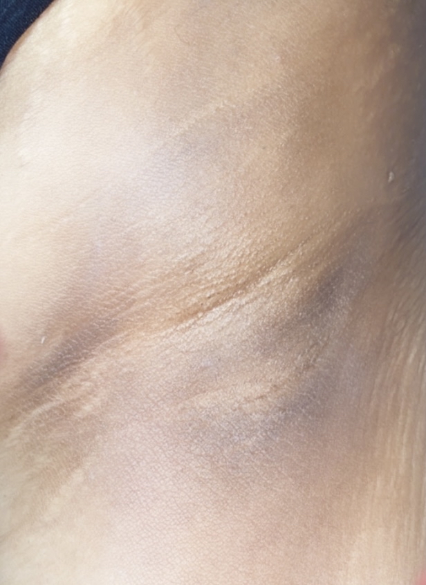 Underarms