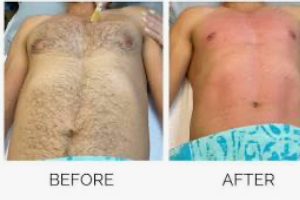 Chest Wax