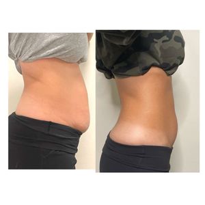 Cavitation/Lipo Package