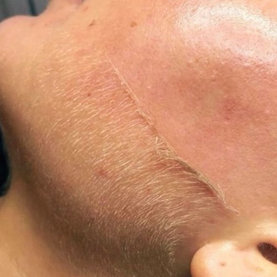 Dermaplane UPGRADE at lillyrosebeauty in Murrieta, CA