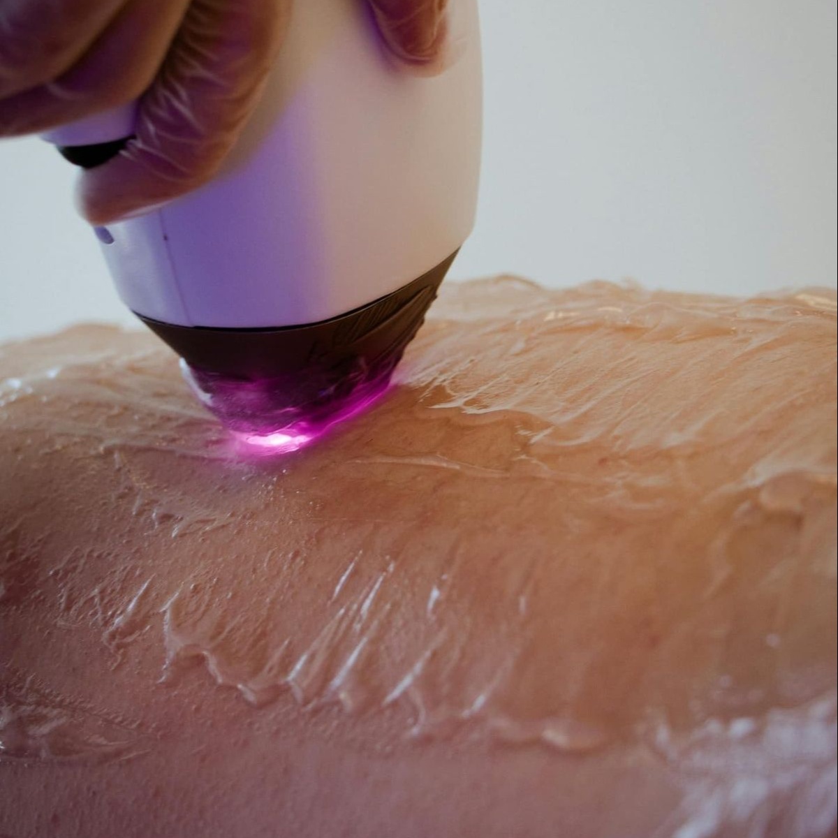 Laser Hair Removal-Lower legs at Fade + Form Skin Aesthetics in Cartersville, GA