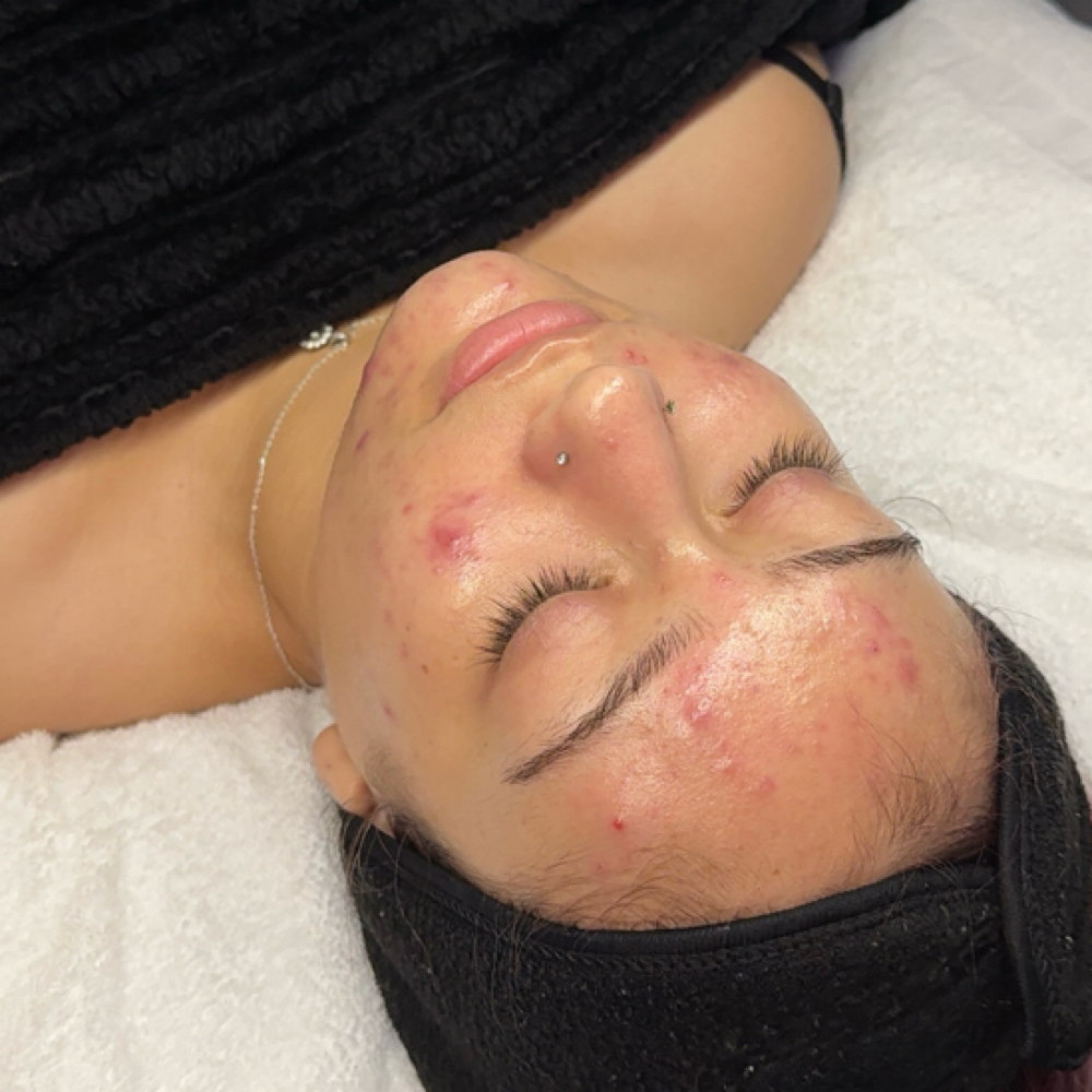 Clarifying Acne Facial at Bare Reflections Studio in Tulare, CA