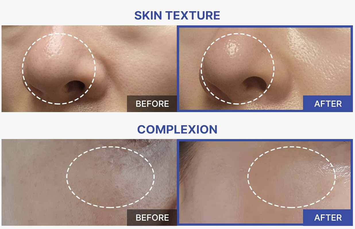 Liquid Microneedling Facial
