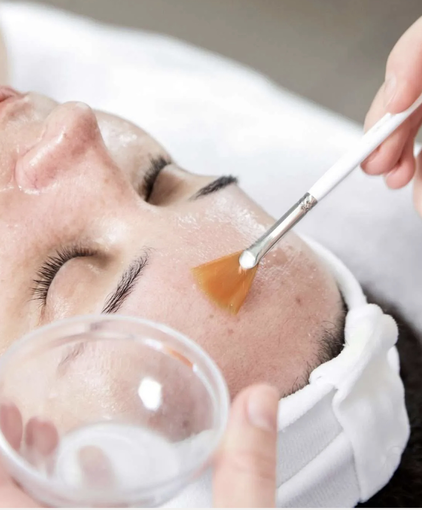 Chemical Peel