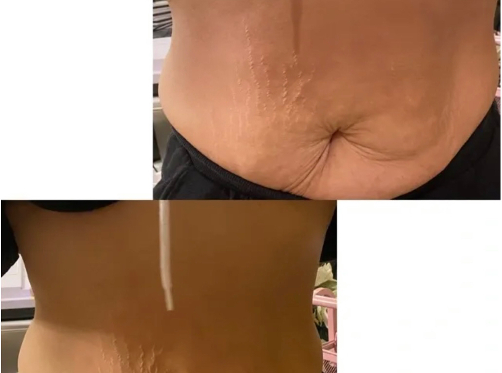 Body Contouring & Cavitation